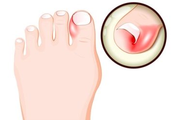 Nagelsvamp – symtom, behandling och hur du blir av med den hemma